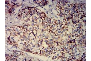 Immunohistochemical analysis of paraffin-embedded bladder cancer tissues using CD239 mouse mAb with DAB staining. (BCAM anticorps  (AA 32-197))