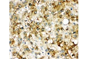 Anti-alpha 1 Antichymotrypsin antibody, IHC(P) IHC(P): Human Liver Cancer Tissue