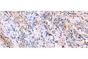 Immunohistochemistry of paraffin-embedded Human cervical cancer tissue using FUCA2 Polyclonal Antibody at dilution of 1:70(x200) (FUCA2 anticorps)