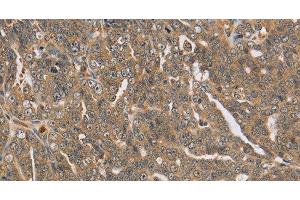 Immunohistochemistry of paraffin-embedded Human cervical cancer using PTPN12 Polyclonal Antibody at dilution of 1:45