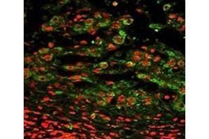 Immunofluorescence analysis of CD11c antibody with paraffin-embedded human hepatocarcinoma.
