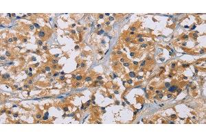 Immunohistochemistry of paraffin-embedded Human thyroid cancer tissue using NME5 Polyclonal Antibody at dilution 1:50 (NME5 anticorps)