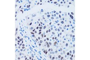 Immunohistochemistry of paraffin-embedded human lung cancer using TP53 antibody (ABIN4905469) at dilution of 1:100 (40x lens). (p53 anticorps)