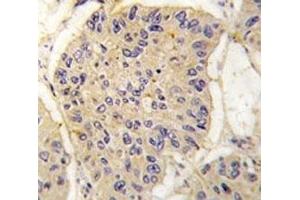 IHC analysis of FFPE human lung carcinoma tissue stained with FKBP12 antibody