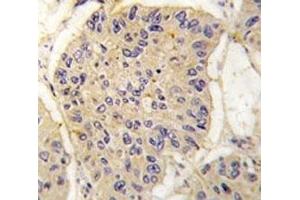 IHC analysis of FFPE human lung carcinoma tissue stained with FKBP12 antibody (FKBP1A anticorps  (AA 43-74))