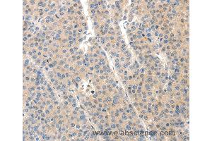 Immunohistochemistry of Human ovarian cancer using SLC20A1 Polyclonal Antibody at dilution of 1:40 (SLC20A1 anticorps)