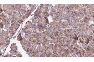 ABIN6273279 at 1/100 staining Human pancreas cancer tissue by IHC-P. (OMA1 anticorps  (Internal Region))