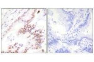 Immunohistochemistry analysis of paraffin-embedded human lung carcinoma tissue using p300 antibody.