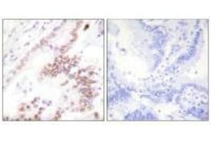 Immunohistochemistry analysis of paraffin-embedded human lung carcinoma tissue using p300 antibody. (PTGER3 anticorps  (N-Term))