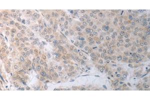 Immunohistochemistry of paraffin-embedded Human liver cancer using RBMS3 Polyclonal Antibody at dilution of 1:70 (RBMS3 anticorps)