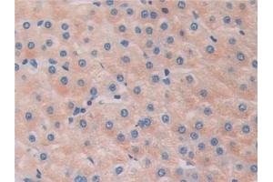 Detection of HDAC6 in Human Liver cancer Tissue using Polyclonal Antibody to Histone Deacetylase 6 (HDAC6)