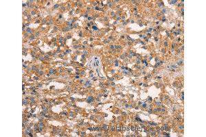 Immunohistochemistry of Human thyroid cancer using ART4 Polyclonal Antibody at dilution of 1:50