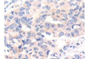 Detection of IL7 in Human Breast cancer Tissue using Polyclonal Antibody to Interleukin 7 (IL7) (IL-7 anticorps  (AA 26-177))