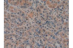 Detection of uPAR in Human Liver cancer Tissue using Polyclonal Antibody to Plasminogen Activator, Urokinase Receptor (uPAR)