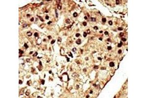 IHC analysis of FFPE human hepatocarcinoma stained with the TRPM7 antibody