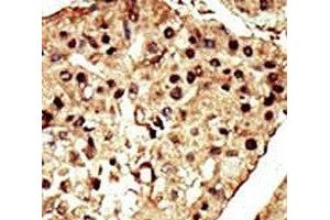 IHC analysis of FFPE human hepatocarcinoma stained with the TRPM7 antibody (TRPM7 anticorps  (AA 1821-1850))