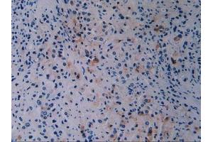 Detection of BRCA1 in Human Prostate Gland Cancer Tissue using Polyclonal Antibody to Breast Cancer Susceptibility Protein 1 (BRCA1) (BRCA1 anticorps  (AA 19-83))