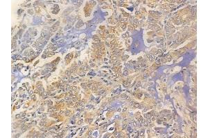ABIN6255906 and ABIN6266459 at 1/100 staining human lung adenocarcinoma by IHC-P.
