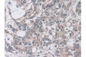 Detection of GAMT in Human Stomach cancer Tissue using Polyclonal Antibody to Guanidinoacetate-N-Methyltransferase (GAMT)