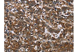 The image on the left is immunohistochemistry of paraffin-embedded Human liver cancer tissue using ABIN7191586(NCKAP1 Antibody) at dilution 1/30, on the right is treated with synthetic peptide. (NCKAP1 anticorps)