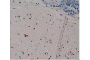 IHC-P analysis of Human Breast Cancer Tissue, with DAB staining. (S100P anticorps  (AA 1-95))