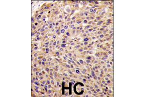 Formalin-fixed and paraffin-embedded human hepatocellular carcinoma reacted with GGPS1 polyclonal antibody  , which was peroxidase-conjugated to the secondary antibody, followed by DAB staining . (GGPS1 anticorps  (N-Term))