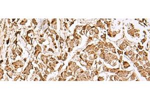 Immunohistochemistry of paraffin-embedded Human breast cancer tissue using MECR Polyclonal Antibody at dilution of 1:70(x200)