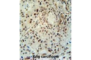 ABHEB Antibody (C-term) immunohistochemistry analysis in formalin fixed and paraffin embedded human lung carcinoma followed by peroxidase conjugation of the secondary antibody and DAB staining. (ABHD14B anticorps  (C-Term))