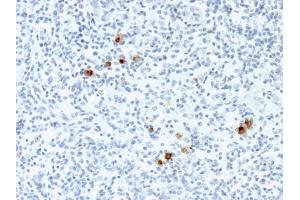 Formalin-fixed, paraffin-embedded human Hodgkin's Lymphoma stained with EBV Mouse Monoclonal Antibody (CS-4). (EBV LMP1 anticorps)