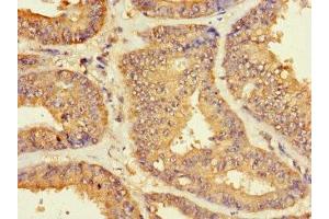 Immunohistochemistry of paraffin-embedded human endometrial cancer using ABIN7176145 at dilution of 1:100