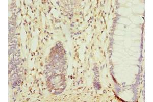 Immunohistochemistry of paraffin-embedded human colon cancer using ABIN7148064 at dilution of 1:100 (CCDC16 anticorps  (AA 1-280))