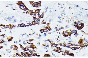 Immunohistochemistry of paraffin-embedded Human lung cancer using MMP25 Polyclonal Antibody at dilution of 1:100 (40x lens). (MMP25 anticorps)