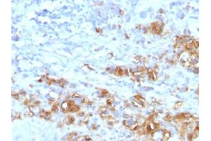 Formalin-fixed, paraffin-embedded human Gastric Carcinoma stained with CA19-9 Rabbit Recombinant Monoclonal Antibody (CA19. (CA 19-9 anticorps)