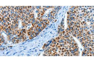 Immunohistochemistry of paraffin-embedded Human liver cancer using ALDH4A1 Polyclonal Antibody at dilution of 1:45