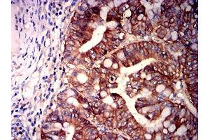 Immunohistochemical analysis of paraffin-embedded rectum cancer tissues using CD147 mouse mAb with DAB staining. (CD147 anticorps  (AA 138-323))