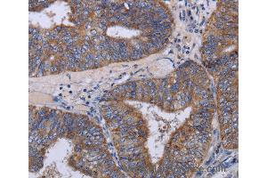 Immunohistochemistry of Human esophagus cancer using MT3 Polyclonal Antibody at dilution of 1:50 (MT3 anticorps)