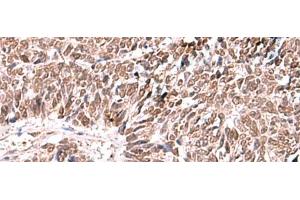 Immunohistochemistry of paraffin-embedded Human lung cancer tissue using FDPS Polyclonal Antibody at dilution of 1:60(x200) (FDPS anticorps)