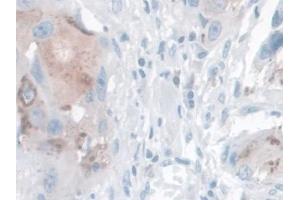 Detection of KLK14 in Human Breast cancer Tissue using Polyclonal Antibody to Kallikrein 14 (KLK14) (Kallikrein 14 anticorps  (AA 36-267))