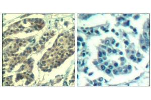 Immunohistochemical analysis of paraffin-embedded human breast carcinoma tissue using Cyclin B1(Phospho-Ser147) Antibody(left) or the same antibody preincubated with blocking peptide(right). (Cyclin B1 anticorps  (pSer147))