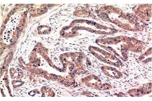 Immunohistochemistry of paraffin-embedded Human breast carcinoma tissue using Phospho-AKT1 (Ser473) Monoclonal Antibody at dilution of 1:200 (AKT1 anticorps  (pSer473))