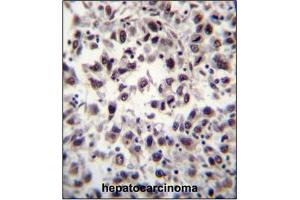 Immunohistochemistry analysis in Formalin Fixed, Paraffin Embedded Human Hepatocarcinoma tissue stained with SFRS7 Antibody (N-term) followed by peroxidase conjugation of the secondary antibody and DAB staining. (SFRS7 anticorps  (N-Term))