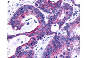 Anti-O3FAR1 / GPR120 antibody IHC of human Colon, Carcinoma.