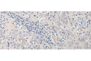 Immunohistochemistry of paraffin-embedded Human cervical cancer tissue using LYRM2 Polyclonal Antibody at dilution of 1:50(x200) (LYRM2 anticorps)