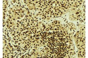 ABIN6276991 at 1/100 staining Human breast cancer tissue by IHC-P. (PSMB5 anticorps  (C-Term))