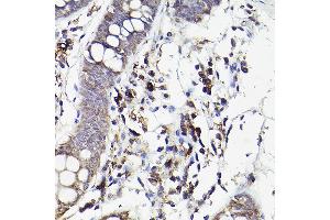 Immunohistochemistry of paraffin-embedded human colon using IL6R Rabbit pAb (ABIN3015521, ABIN3015522, ABIN3015523, ABIN1680455 and ABIN6218635) at dilution of 1:50 (40x lens). (IL-6 Receptor anticorps  (AA 20-320))