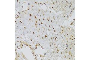 Immunohistochemistry of paraffin-embedded human leiomyoma of uterus using HNRNPA1 Antibody (ABIN5975570) at dilution of 1/100 (40x lens). (HNRNPA1 anticorps)