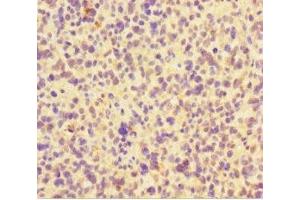 Immunohistochemistry of paraffin-embedded human glioma using ABIN7165362 at dilution of 1:100 (FAM117B anticorps  (AA 1-200))