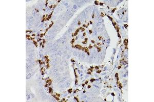 Immunohistochemistry of paraffin-embedded human colon carcinoma using S100 Rabbit pAb (842) at dilution of 1:100 (40x lens).