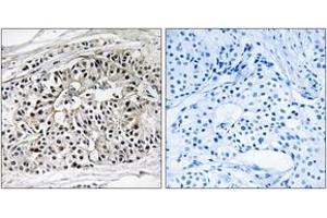 Immunohistochemistry analysis of paraffin-embedded human breast carcinoma tissue, using EHHADH Antibody.