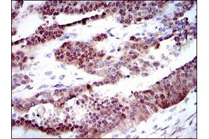Immunohistochemical analysis of paraffin-embedded ovarian cancer tissues using CYP1A1 mouse mAb with DAB staining.